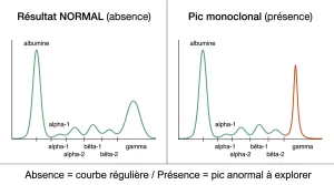 Absence d&rsquo;immunoglobuline monoclonale : ce que dit vraiment ce résultat