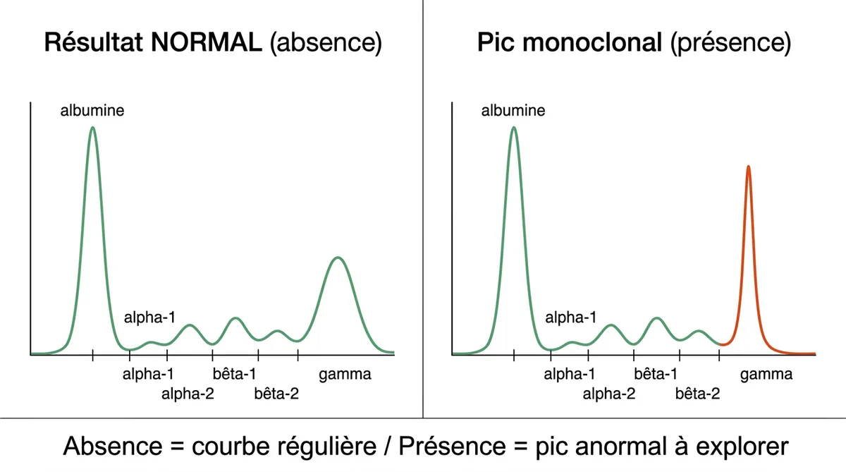 Absence d&rsquo;immunoglobuline monoclonale : ce que dit vraiment ce résultat